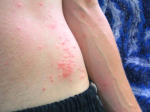 bites-mosquitoes-in-hawaii